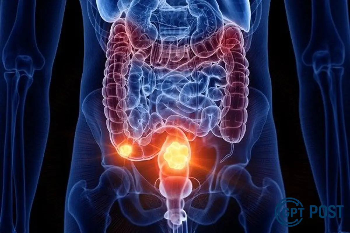 Imagem principal da notícia: Câncer de Intestino: Conheça a doença que levou Preta Gil e como combatê-la