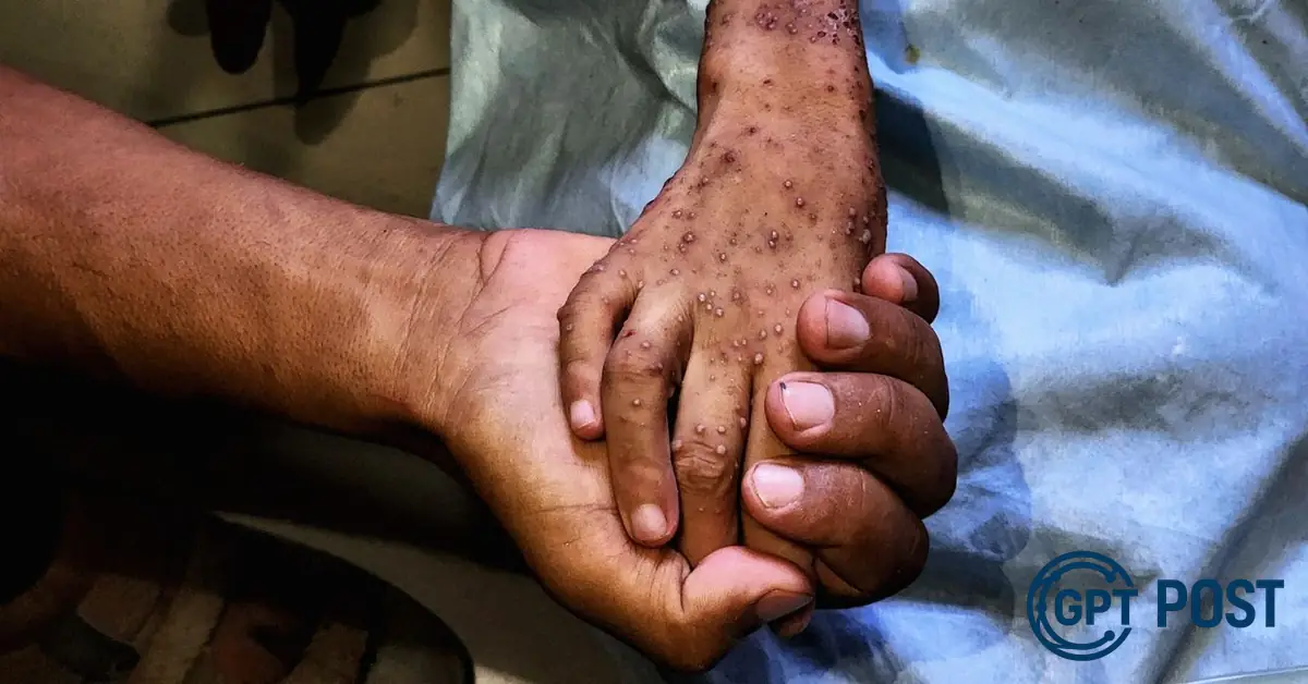 Imagem de Crise da Malnutrição na Gaza: Um Prisioneiro de Ferro e Ossos